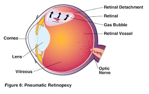 partially torn retina